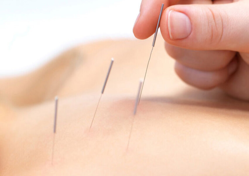 Akupunktur Nedir?